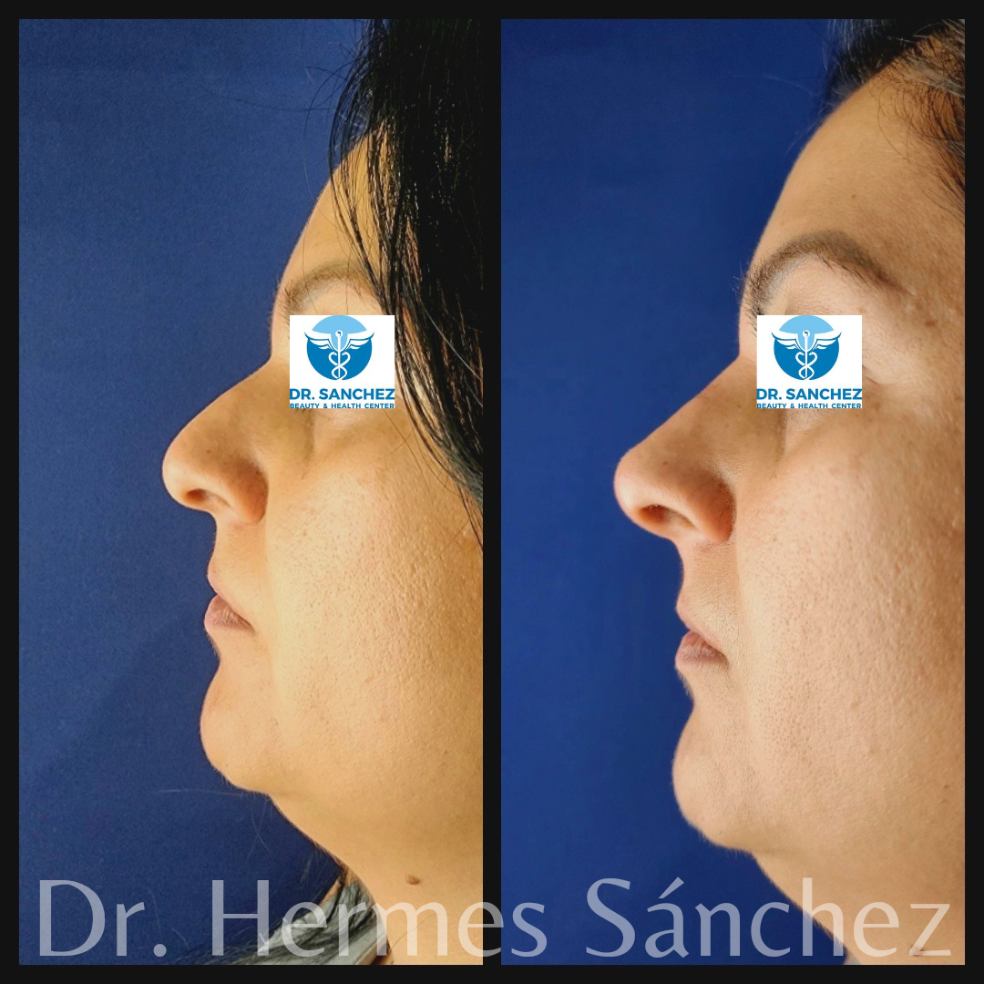 Galería - Transformación 13